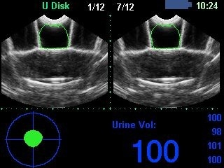 BVT02 Bladder scanner